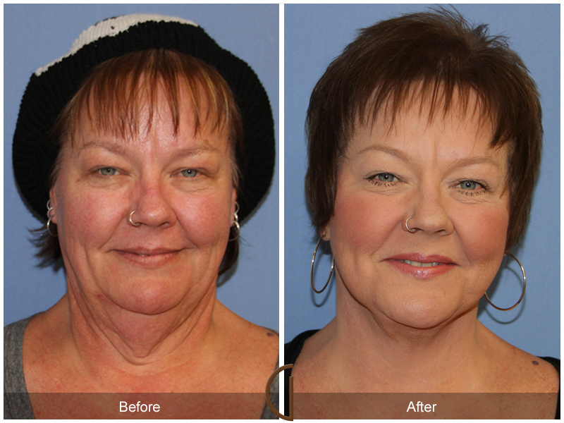 Female Facelift  Before & After Image