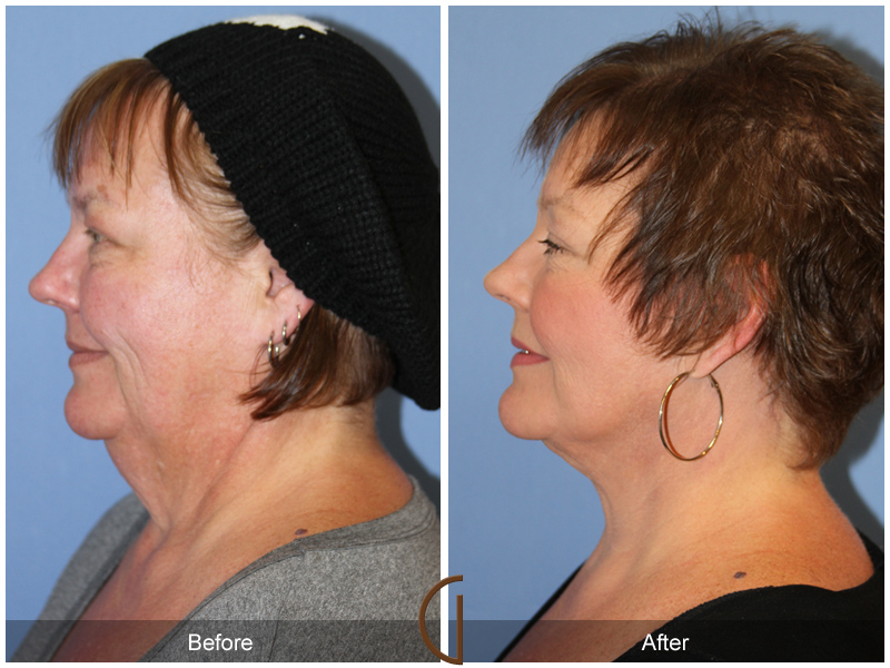 Female Facelift  Before & After Image