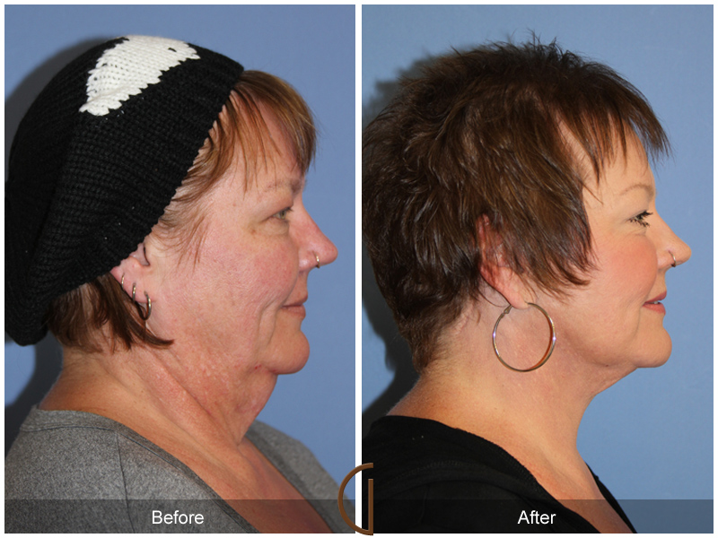 Female Facelift  Before & After Image