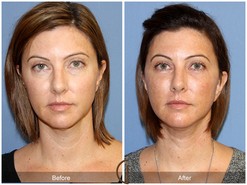 Female Facelift  Before & After Image