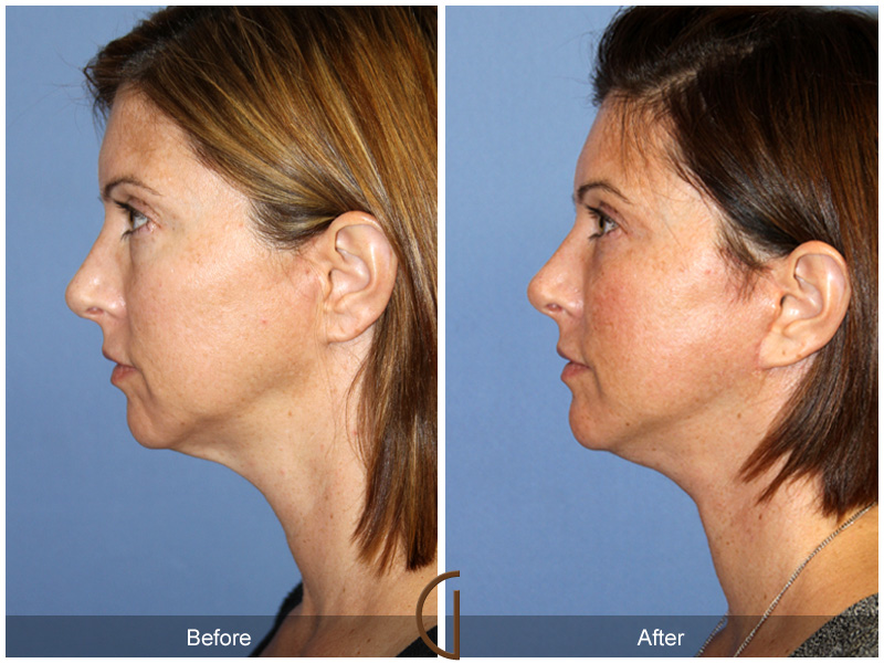 Female Facelift  Before & After Image