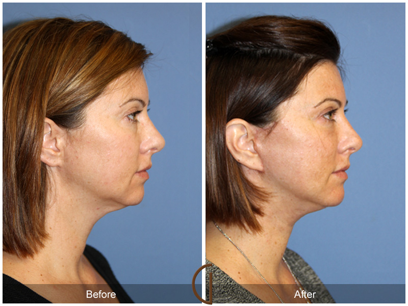 Female Facelift  Before & After Image