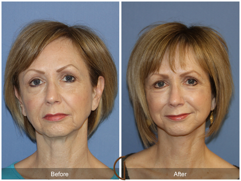 Female Facelift  Before & After Image