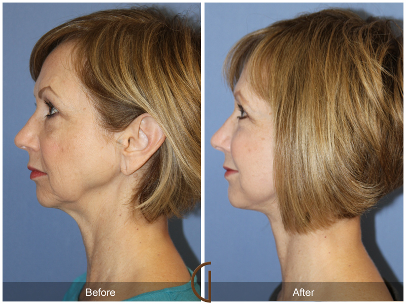 Female Facelift  Before & After Image