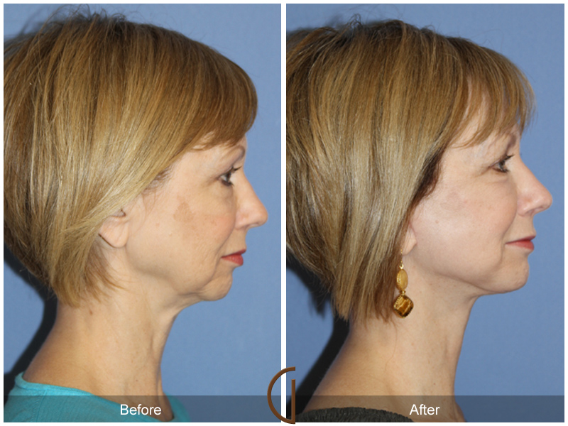 Female Facelift  Before & After Image