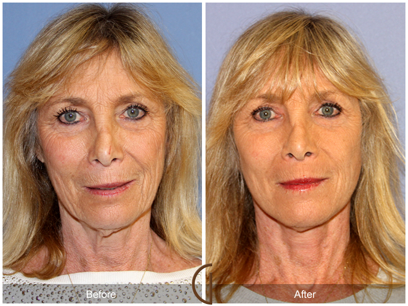 Female Facelift  Before & After Image