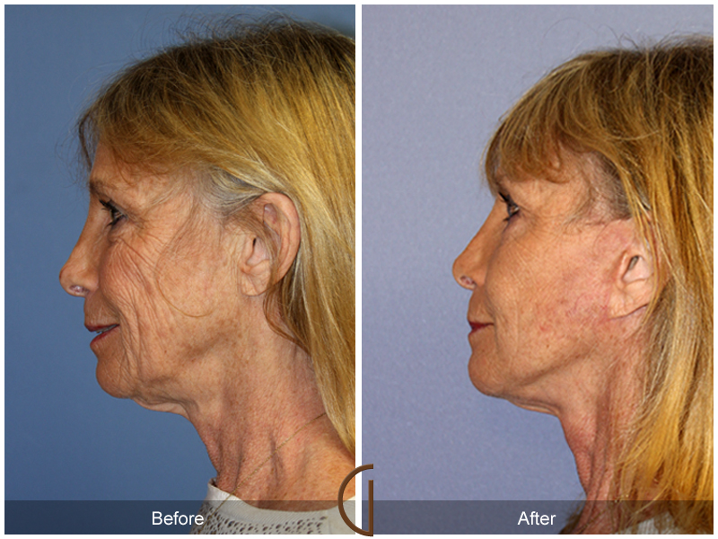 Female Facelift  Before & After Image