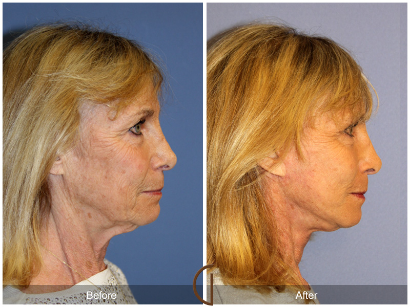 Female Facelift  Before & After Image