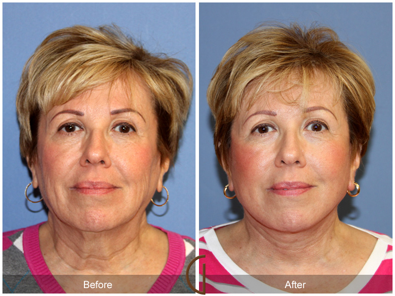 Female Facelift  Before & After Image