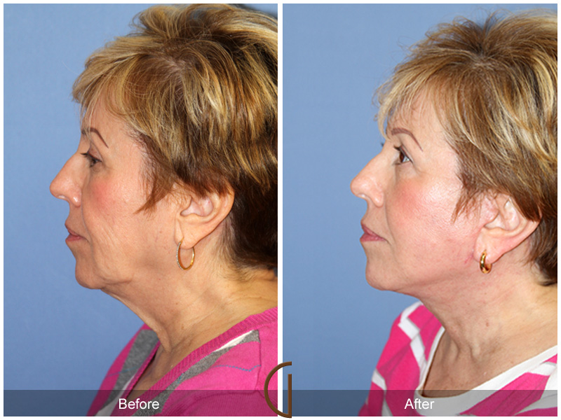 Female Facelift  Before & After Image