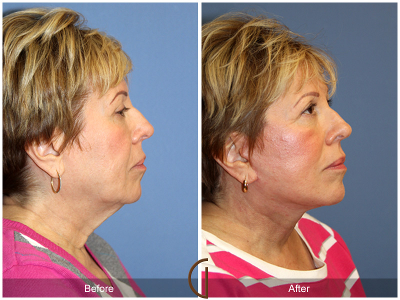 Female Facelift  Before & After Image