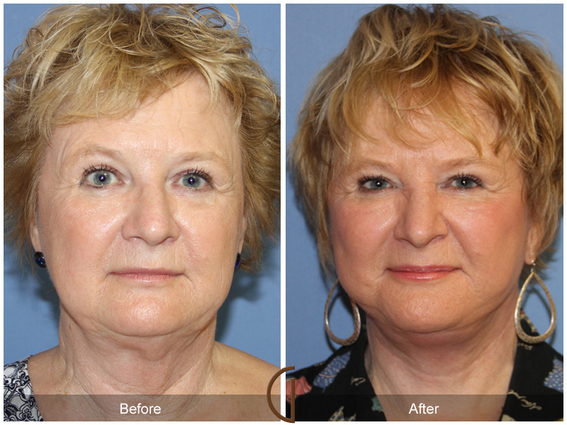 Female Facelift  Before & After Image