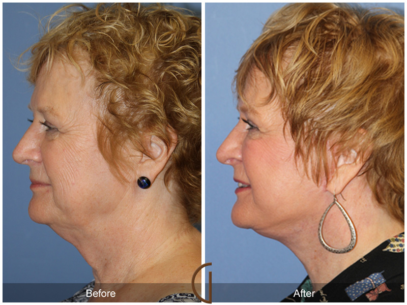 Female Facelift  Before & After Image