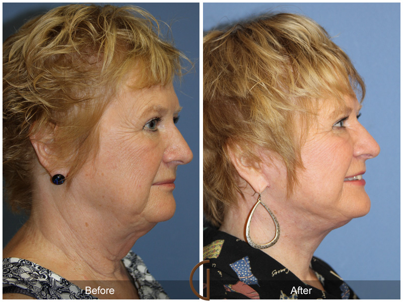 Female Facelift  Before & After Image