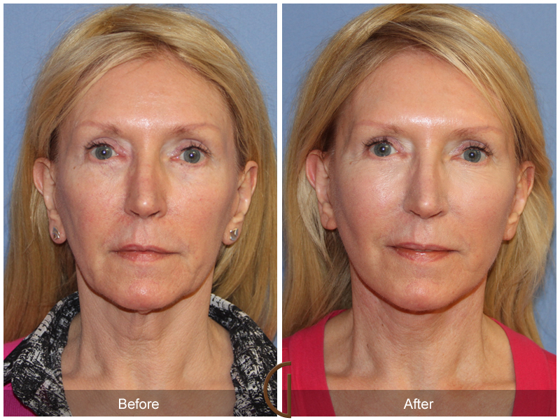 Female Facelift  Before & After Image