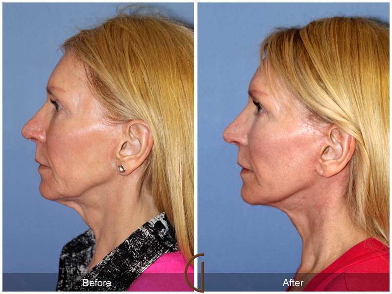 Female Facelift  Before & After Image