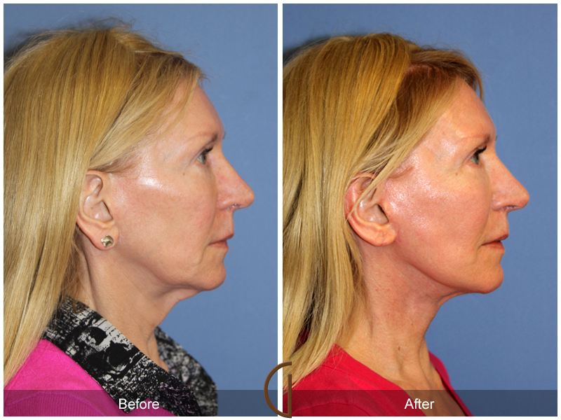 Female Facelift  Before & After Image