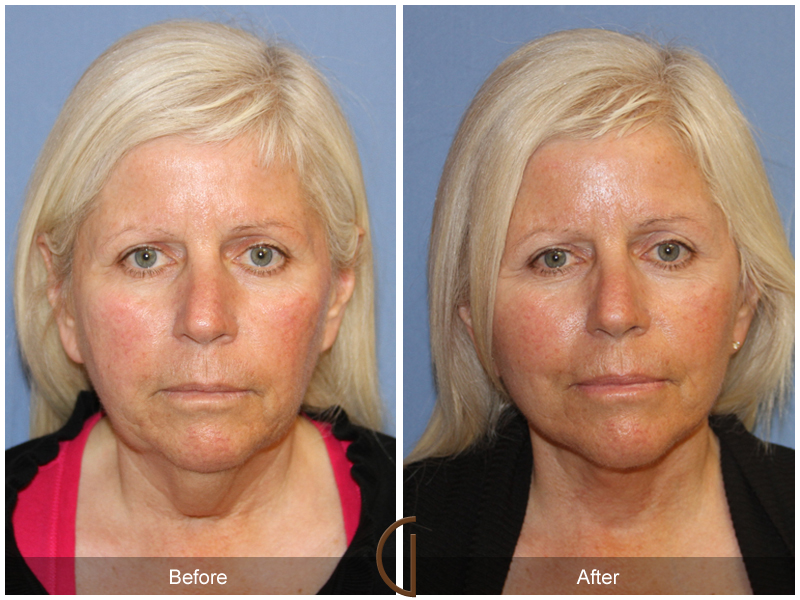 Female Facelift  Before & After Image