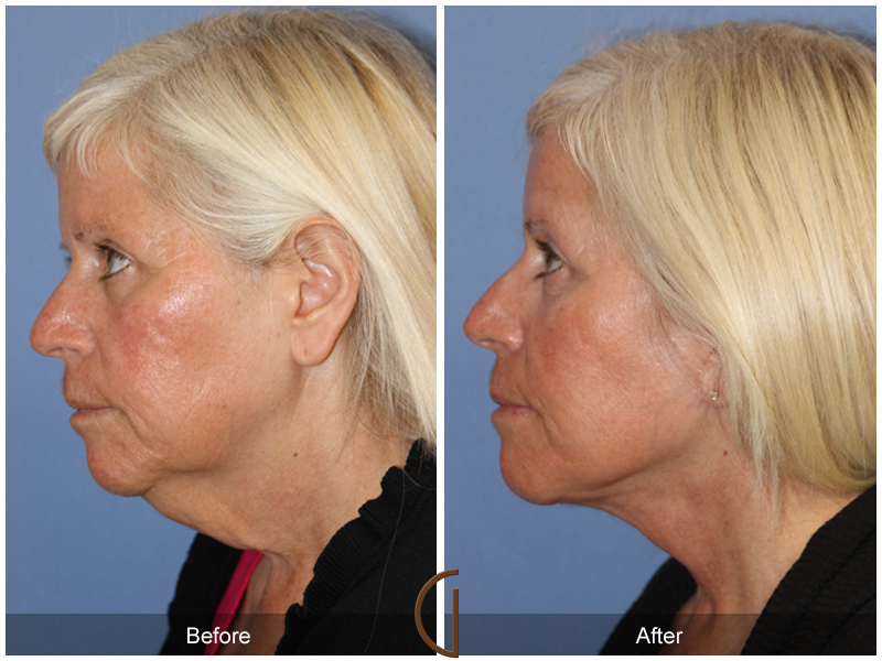 Female Facelift  Before & After Image