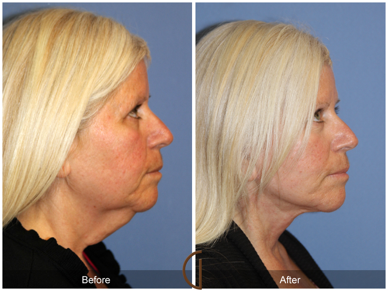 Female Facelift  Before & After Image