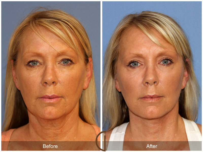 Female Facelift  Before & After Image