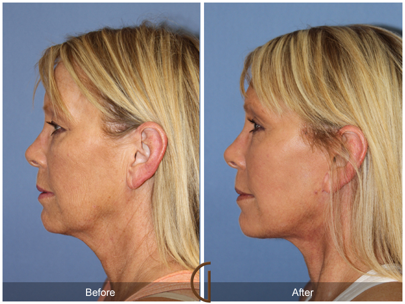 Female Facelift  Before & After Image