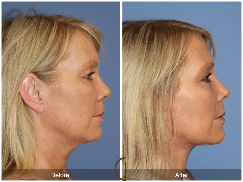 Female Facelift  Before & After Image