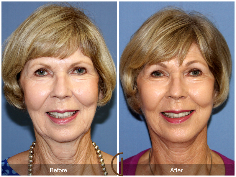 Female Facelift  Before & After Image