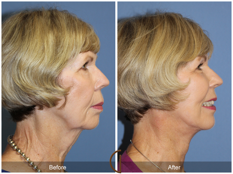 Female Facelift  Before & After Image