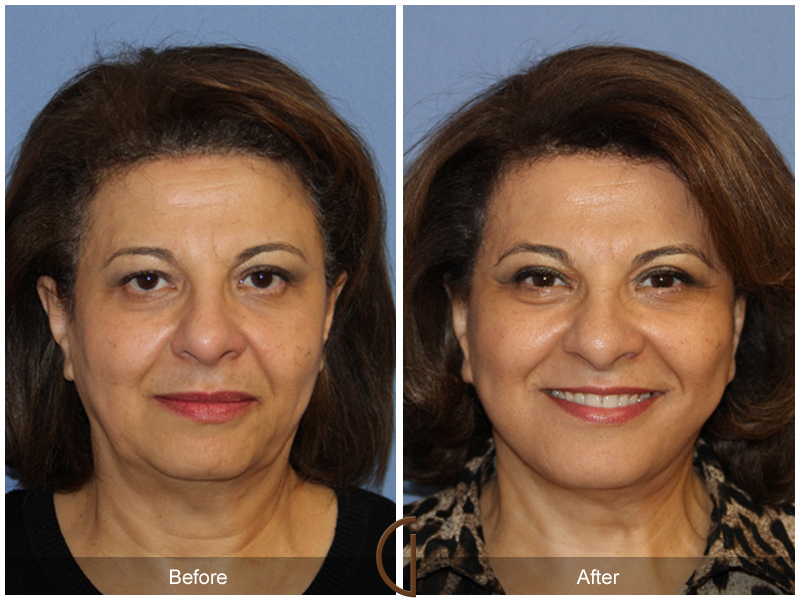 Female Facelift  Before & After Image