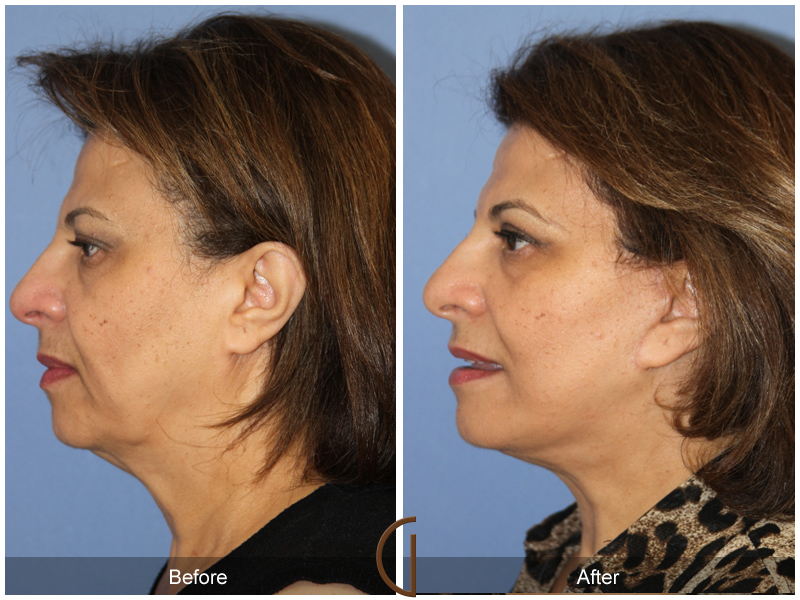 Female Facelift  Before & After Image