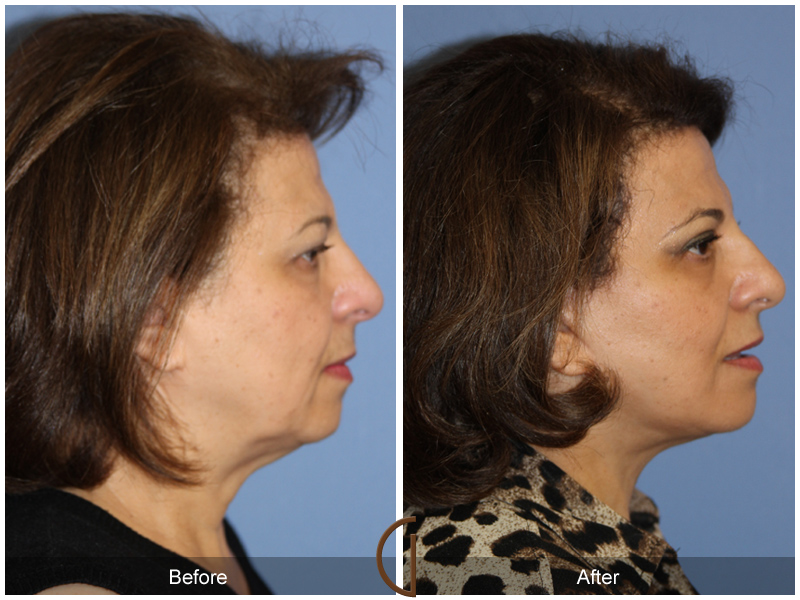 Female Facelift  Before & After Image