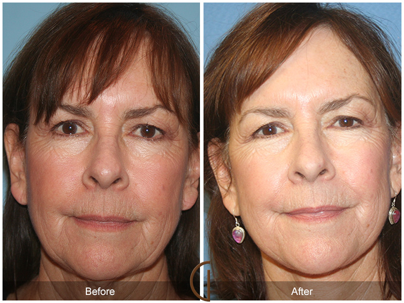 Female Facelift  Before & After Image