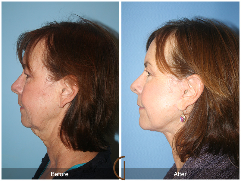 Female Facelift  Before & After Image