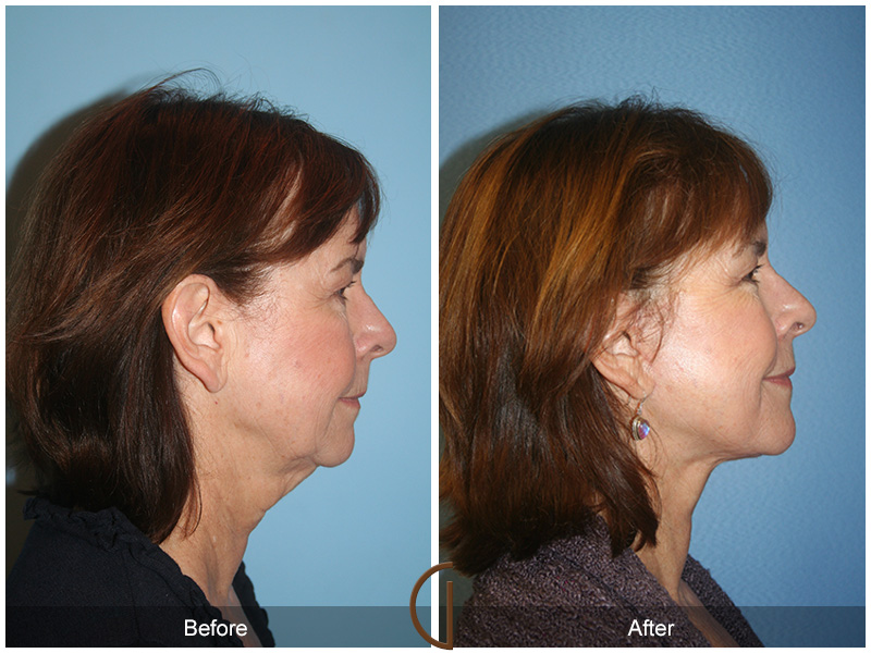 Female Facelift  Before & After Image