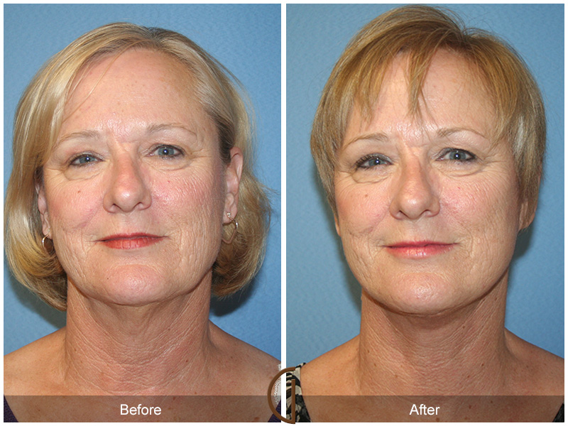 Female Facelift  Before & After Image