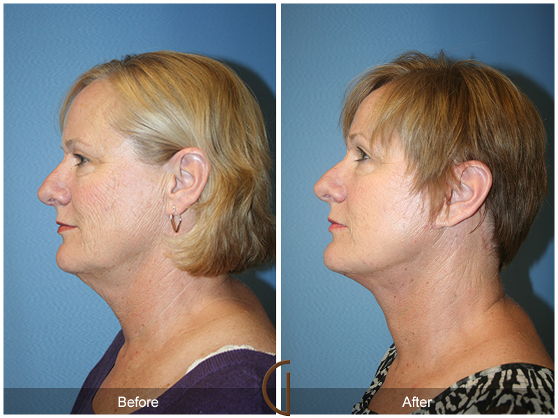 Female Facelift  Before & After Image