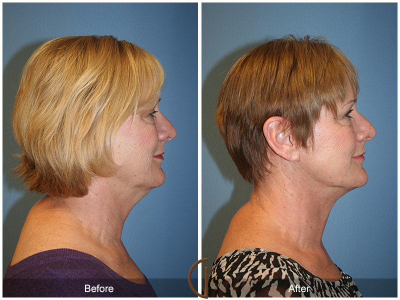 Female Facelift  Before & After Image