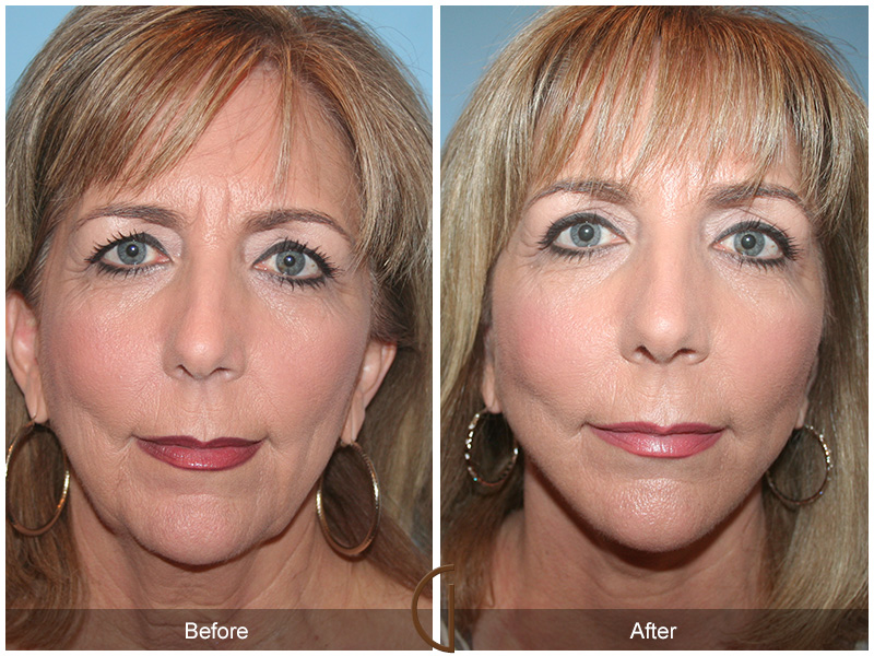 Female Facelift  Before & After Image