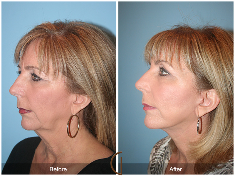 Female Facelift  Before & After Image