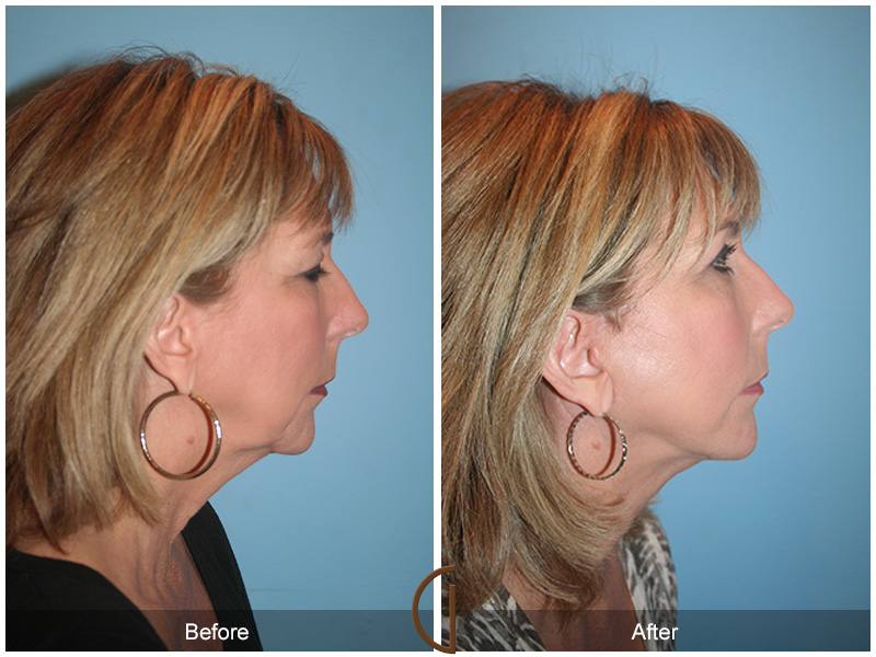 Female Facelift  Before & After Image