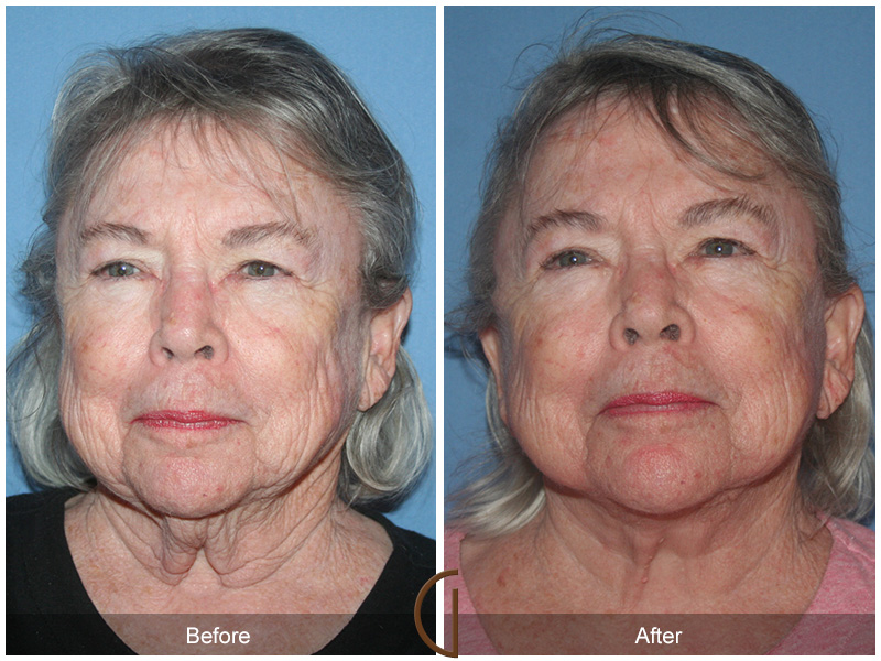 Female Facelift  Before & After Image