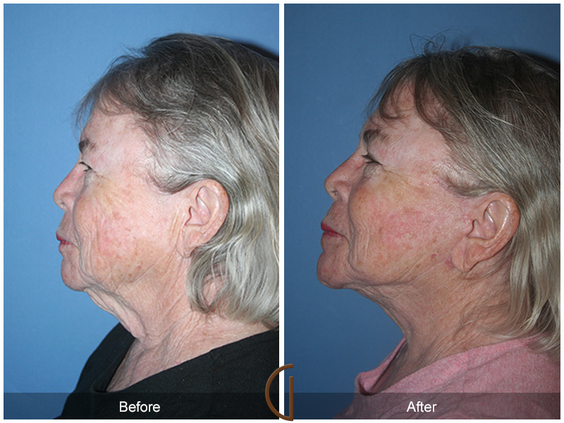 Female Facelift  Before & After Image