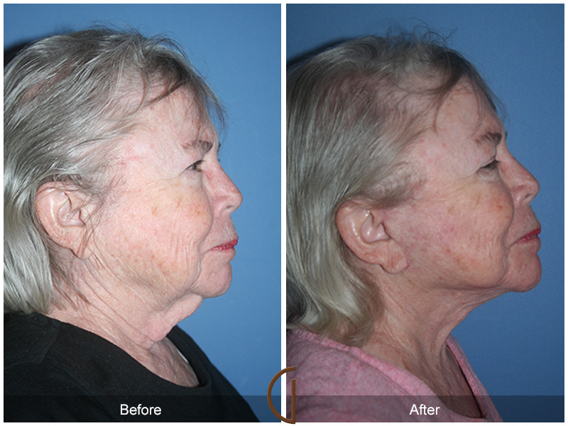 Female Facelift  Before & After Image