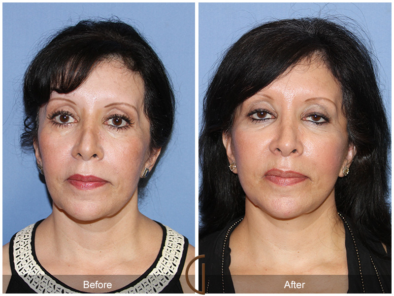 Female Facelift  Before & After Image