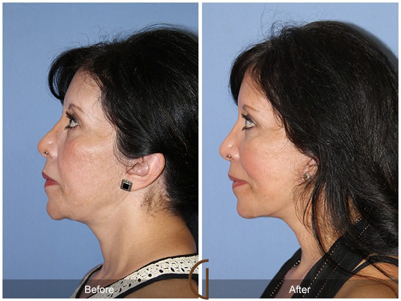 Female Facelift  Before & After Image