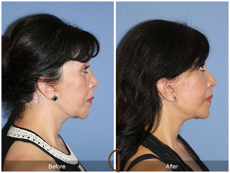 Female Facelift  Before & After Image