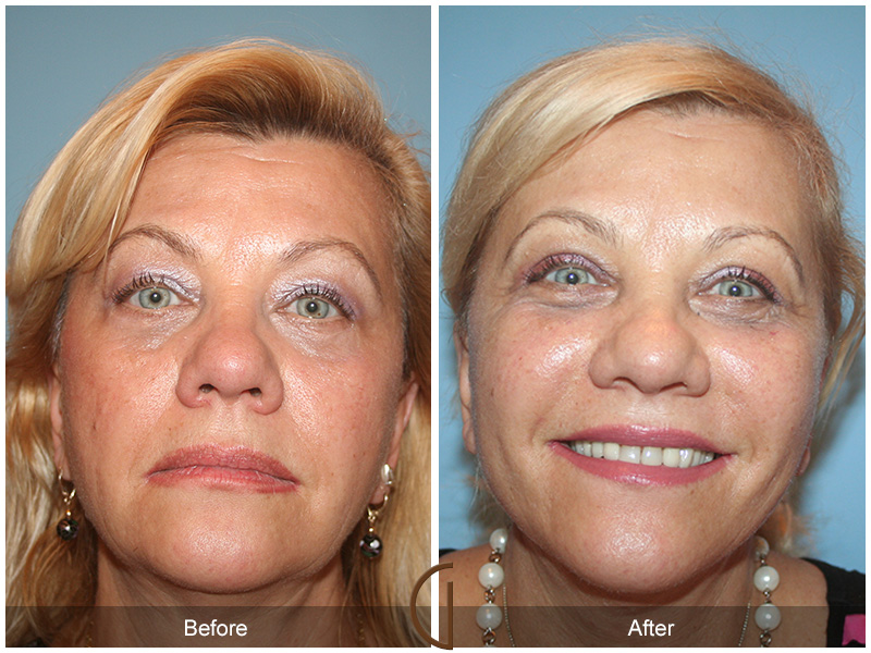 Female Facelift  Before & After Image