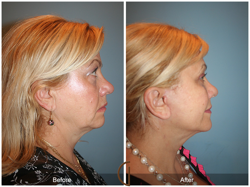 Female Facelift  Before & After Image