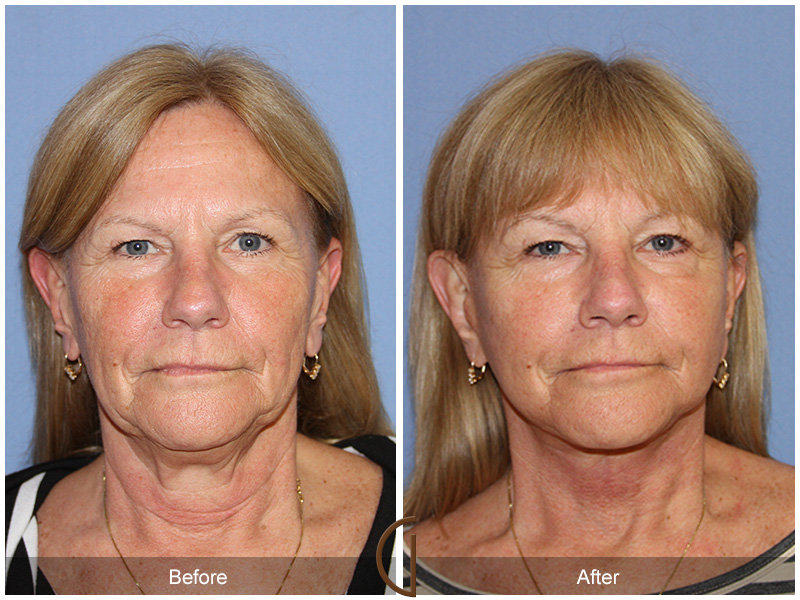 Female Facelift  Before & After Image